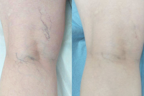 Что происходит с сосудами при появлении звездочек