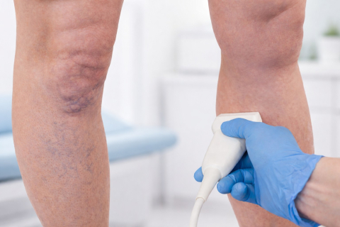 Сосудистые звездочки на ногах - это уже варикоз или нет